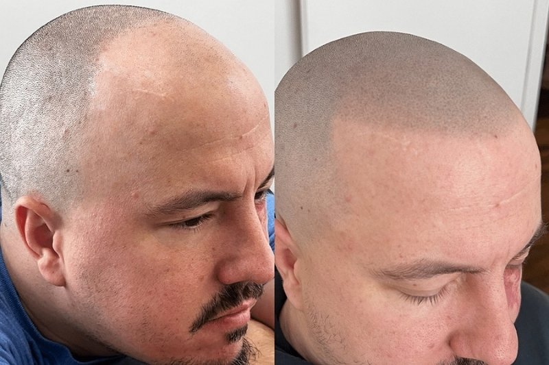 Alopecia & Scalp Micropigmentation (SMP)