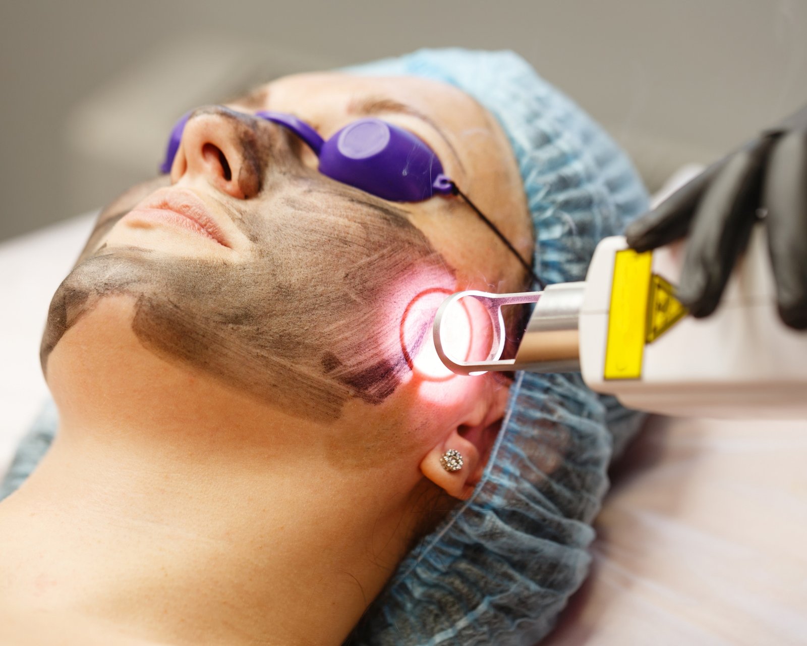 CO2 Fractional Laser Resurfacing