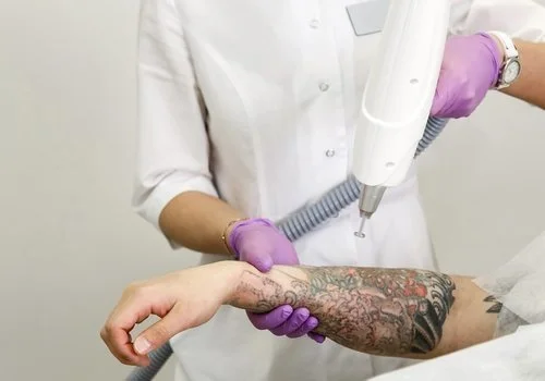 Laser Tattoo Removal