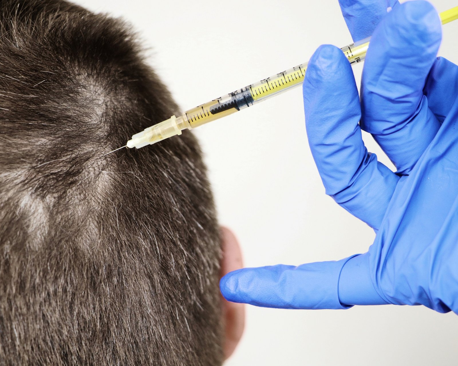 PRP Hair Regrowth Therapy